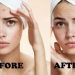 علاج حب الشباب بالخلايا الجذعية